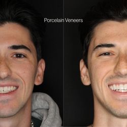 Dentalvana - Smile makeover with 10 upper veneers creating a natural, functional and masculine smile. Cosmetic Dentistry Miami