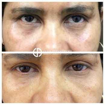 Geria Dermatology - Rutherford - Tear trough filler before and after - Dermatologists Near Me - Rutherford, New Jersey