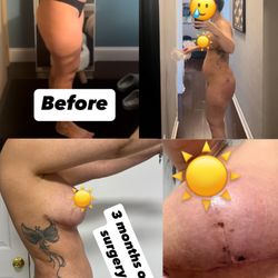 Balto Plastic Surgery - Lipo 360 breast lift with plasma jet and BBL