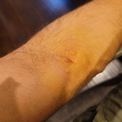BioLife Plasma Services - Hematoma
