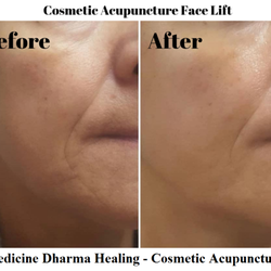 Medicine Dharma Healing - Cheek - Cosmetic Acupuncture