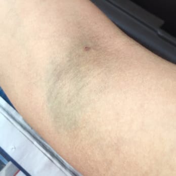 Octapharma Plasma - Colton - Bruised the following morning and very painful to touch - Blood & Plasma Donation Centers Near Me - Colton, California Octapharma Plasma - Colton - Bruised the following morning and very painful to touch - Blood & Plasma Donation Centers Near Me - Colton, California