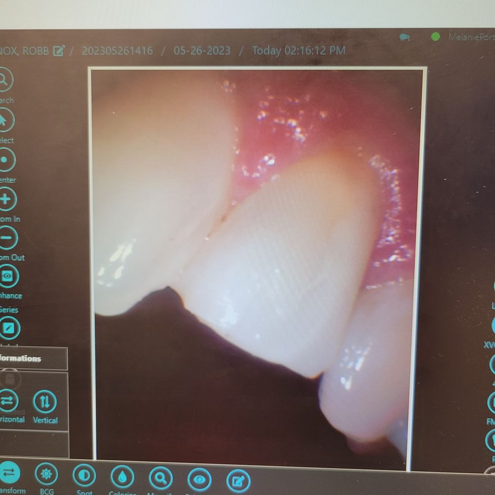 Sasha Drexler Dentistry - Tooth cut in half - General Dentistry Near Me - Fairfield, Connecticut Sasha Drexler Dentistry - Tooth cut in half - General Dentistry Near Me - Fairfield, Connecticut