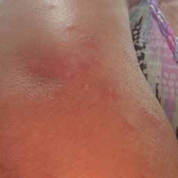 Bug bites from bed from fellow guests! Me too! We are livid! Staff could care less! Bug bites from bed from fellow guests! Me too! We are livid! Staff could care less!