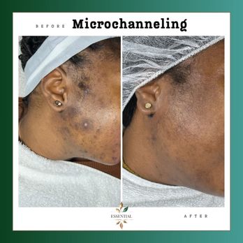 Essential  - Microchanneling is less downtime than micro needling but less likely to cause post inflammatory hyperpigmentation. - Permanent Makeup Near Me - Land O' Lakes, Florida