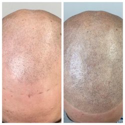 Anthony Farole, DMD - Scalp Micropigmentation