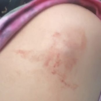 Walgreens - a woman's arm with a scar on it - Drugstores Near Me - Foley, Alabama