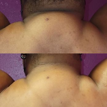 Lyv Natural Beauty - Neck fat removal from first session and fourth session 8 more to go ! - Waxing Near Me Lyv Natural Beauty - Neck fat removal from first session and fourth session 8 more to go ! - Waxing Near Me