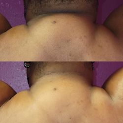 Lyv Natural Beauty - Neck fat removal from first session and fourth session 8 more to go !