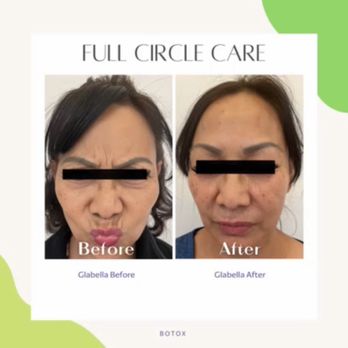 Full Circle Care - Botox before and after - Medical Spas Near Me - Las Vegas, Nevada Full Circle Care - Botox before and after - Medical Spas Near Me - Las Vegas, Nevada