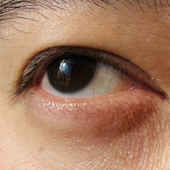 TLC Laser Eye Centers - Optometrists Near Me - Bellevue, Washington