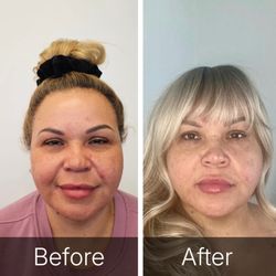Bright Eyes MD - Eyes lifted up and forward and cheeks lifted via signature procedure