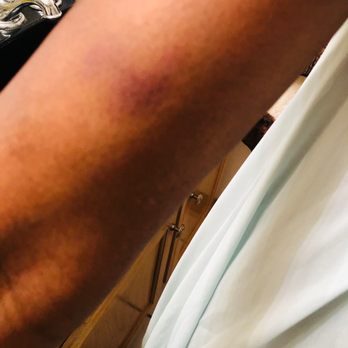 Kroger - Bruise from Insect Bite/Sting - Grocery Near Me - Jackson, Mississippi