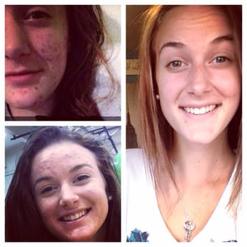 Tracii's Aesthetics - This is Kendall. She started with me 3/2014 in the upper left pic. The right pic is 9/2014. NO PHOTOSHOP!!! Actual pictures. - Day Spas Near Me - Coeur d'Alene, Idaho Tracii's Aesthetics - This is Kendall. She started with me 3/2014 in the upper left pic. The right pic is 9/2014. NO PHOTOSHOP!!! Actual pictures. - Day Spas Near Me - Coeur d'Alene, Idaho