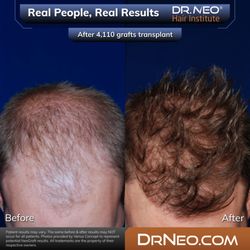 DR. NEO Hair Institute - Palm Desert - Patient underwent a 4,110 graft hair transplant procedure targeting the hairline, frontal region (forelock), temples and crown area.