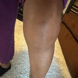 Sports Medicine and Orthopaedic Center - Chesapeake - 10 months post operation. My knee is way bigger than when I first walked into his office!