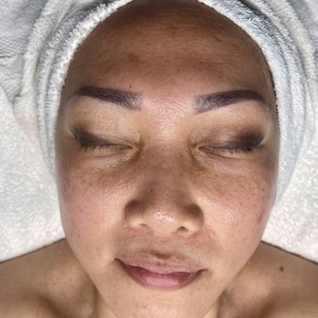 Skin By Char - Before photo taken after my 2nd treatment - hyper-pigmentation, large pores, scaring from previous treatments, bumps on cheeks - Acne Treatment Near Me - Westminster, California Skin By Char - Before photo taken after my 2nd treatment - hyper-pigmentation, large pores, scaring from previous treatments, bumps on cheeks - Acne Treatment Near Me - Westminster, California