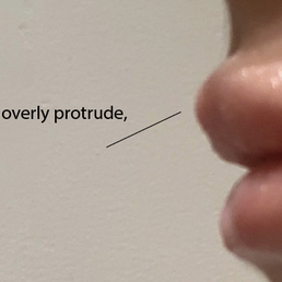 Express filler at my cupids bow causing it to overly protrude.