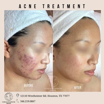 Li Beauty Medspa - Skin Care Near Me - Houston, Texas Li Beauty Medspa - Skin Care Near Me - Houston, Texas