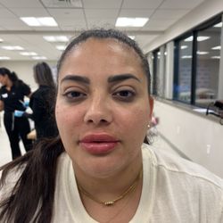 Intentional Wellness Medspa - After lipflip filler