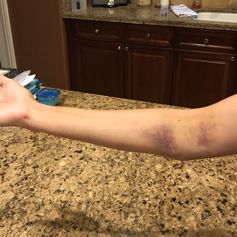 Quest Diagnostics - Bruised arm after my blood draw. This is four days later :( - Laboratory Testing Near Me - Las Vegas, Nevada Quest Diagnostics - Bruised arm after my blood draw. This is four days later :( - Laboratory Testing Near Me - Las Vegas, Nevada