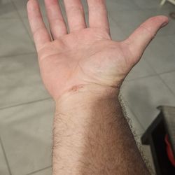 James W Vahey, MD - Right hand carpul tunnel surgery