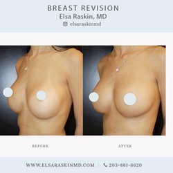 Elsa Raskin, MD - Breast augmentation revision