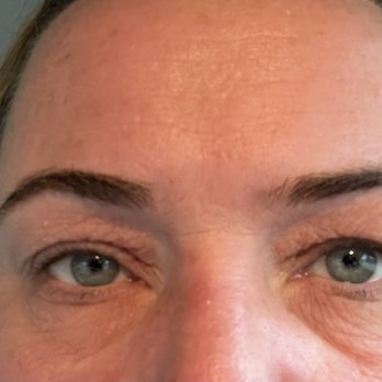 Supreme Medical Center - Before eyebrows - Laser Hair Removal Near Me - Willowbrook, Illinois Supreme Medical Center - Before eyebrows - Laser Hair Removal Near Me - Willowbrook, Illinois