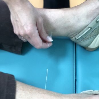 Conscious Wellness - Acupuncture with Dr. Julie can provide relaxation and is painless. - Chiropractors Near Me - Akron, Ohio Conscious Wellness - Acupuncture with Dr. Julie can provide relaxation and is painless. - Chiropractors Near Me - Akron, Ohio