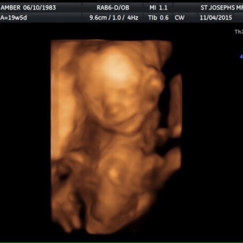 Miracle View 3D/4D Ultrasound - Ultrasound from 19 weeks - Obstetricians & Gynecologists Near Me - Phoenix, Arizona Miracle View 3D/4D Ultrasound - Ultrasound from 19 weeks - Obstetricians & Gynecologists Near Me - Phoenix, Arizona