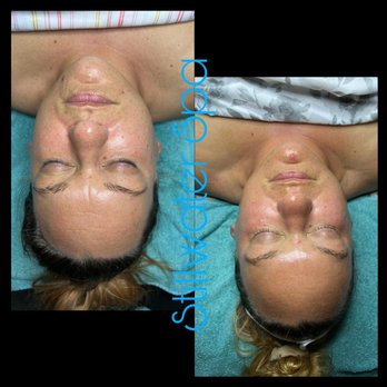 Stillwater Spa - Before and after a month on Circadia skin care routine! - Massage Near Me - Sussex, Wisconsin Stillwater Spa - Before and after a month on Circadia skin care routine! - Massage Near Me - Sussex, Wisconsin