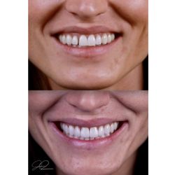 Davis Dental - Fix gaps in teeth!