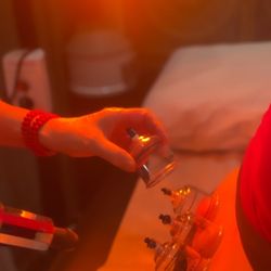 Medical Acupuncture - Lake Mary - Magic of cupping therapy