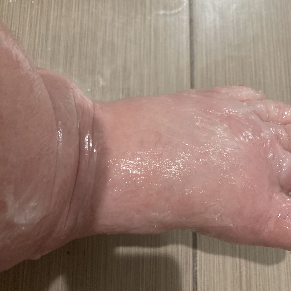 Cornerstone Caregiving- Katy - pic of my cellulitis - Personal Care Services Near Me - Katy, Texas Cornerstone Caregiving- Katy - pic of my cellulitis - Personal Care Services Near Me - Katy, Texas