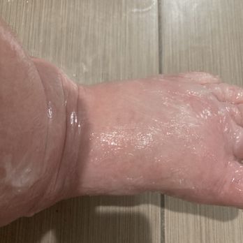 Cornerstone Caregiving- Katy - pic of my cellulitis - Personal Care Services Near Me - Katy, Texas