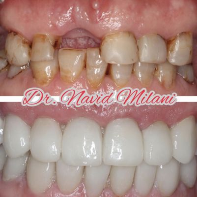 Before and Afters - From implants to veneers, our staff is fully trained for all your cosmetic dentistry needs. If you have any questions or would like to schedule a free consultation, call us today and mention YELP! Before and Afters - From implants to veneers, our staff is fully trained for all your cosmetic dentistry needs. If you have any questions or would like to schedule a free consultation, call us today and mention YELP!