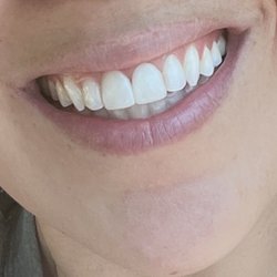 Ryan Hong, DDS - Anaheim Hills Family Dental - Her are my teeth after my visit with Dr. Hong .. my front teeth are improved and look great !