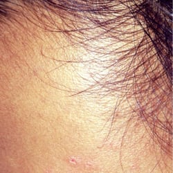 Cuts above eyes