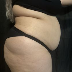 Austin Plastic Surgeon - Belly