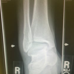 Kathleen M Halat, DPM - Broken fibula!!