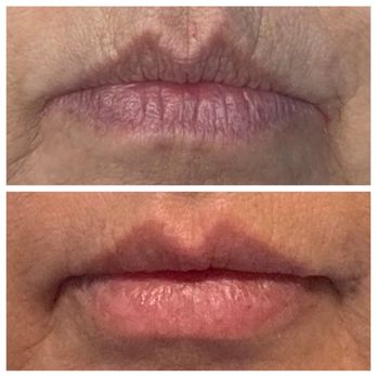 Uplift Medspa - Before and after. Very natural results! - Medical Spas Near Me - Plano, Texas