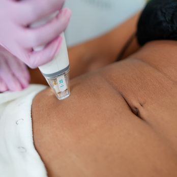 LaserAway - Medical Spas Near Me - Sacramento, California