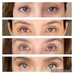 San Diego Eyelid Specialists - Dr. Iyengar is San Diego's top plastic surgeon for blepharoplasty.