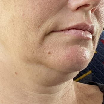 FACEOLOGYMD - Dr. Raymond Lee - Before my procedure, terrible double chin and jowls - Medical Spas Near Me - Newport Beach, California
