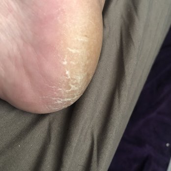 LV Nails & Spa - This is what my heels look like AFTER the pedicure. - Nail Salons Near Me - Henderson, Nevada