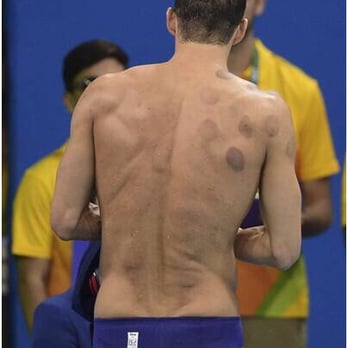 De-Qi Acupuncture - Cupping marks: Circular bruises on Michael Phelps' back (photo from news) - Skin Care Near Me - Bellevue, Washington De-Qi Acupuncture - Cupping marks: Circular bruises on Michael Phelps' back (photo from news) - Skin Care Near Me - Bellevue, Washington