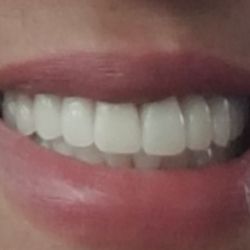 KEMM - Finished veneers kemm clinic