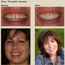 Scott Greenhalgh, DDS - Porcelain Veneers in Denver - Before & After