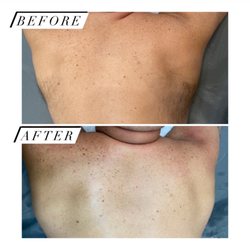 Sugar Smooth - Men's shoulders wax