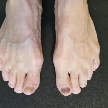REI - Bye bye left toenail for 2nd year in a row... - Bikes Near Me - Sacramento, California REI - Bye bye left toenail for 2nd year in a row... - Bikes Near Me - Sacramento, California